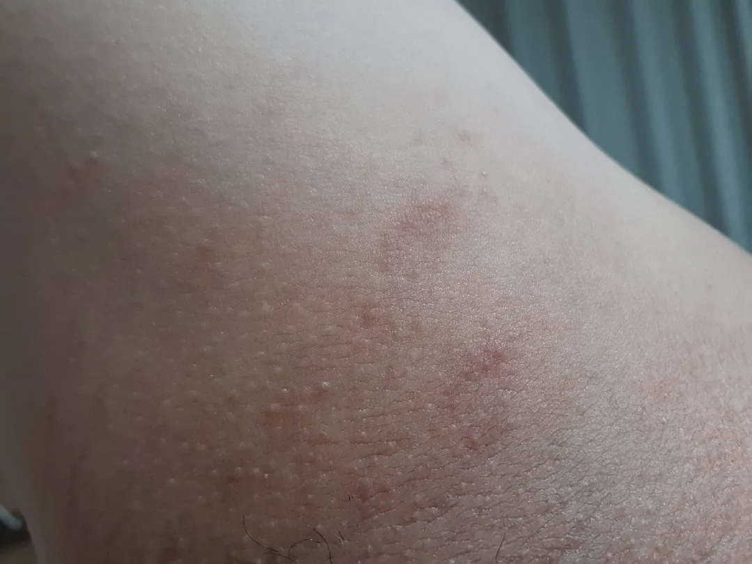 이거 임산부 소양증인가요?