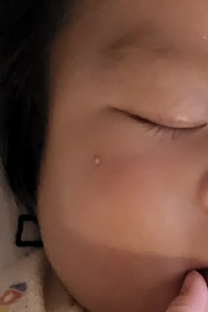아기여드름