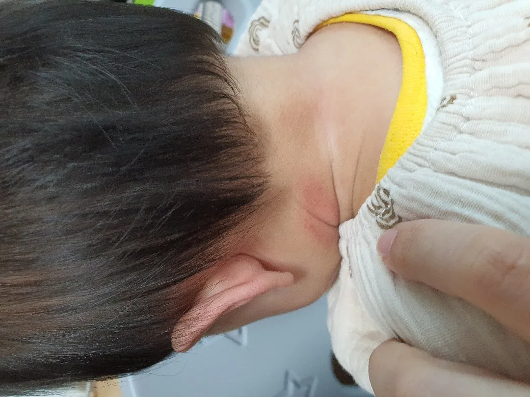 땀띠일까요??
