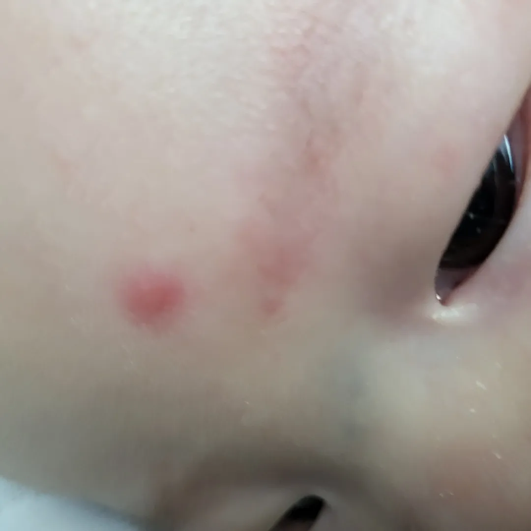 왕뾰루지케어 아시는분..?🥲