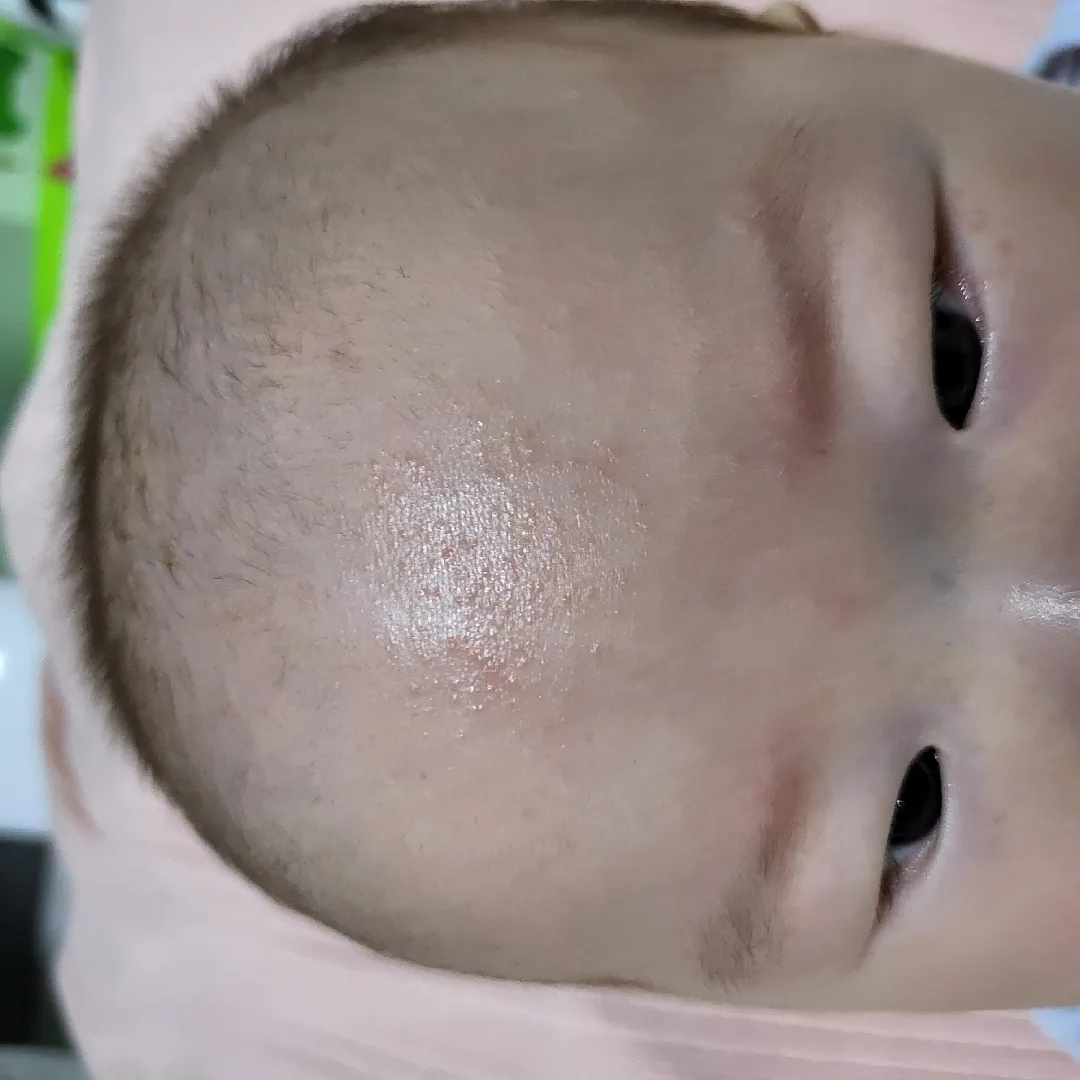 좁쌀여드름인걸까요ㅜㅜ