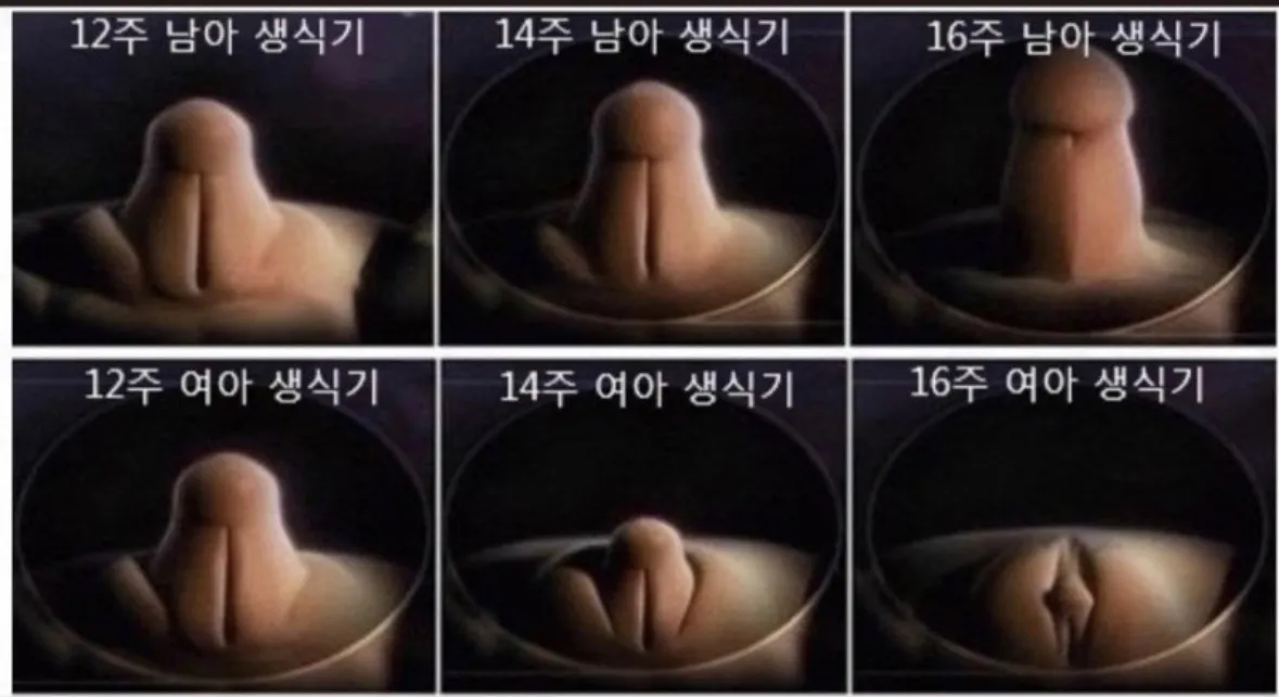 12주 초음파상 태아 생식기 참고