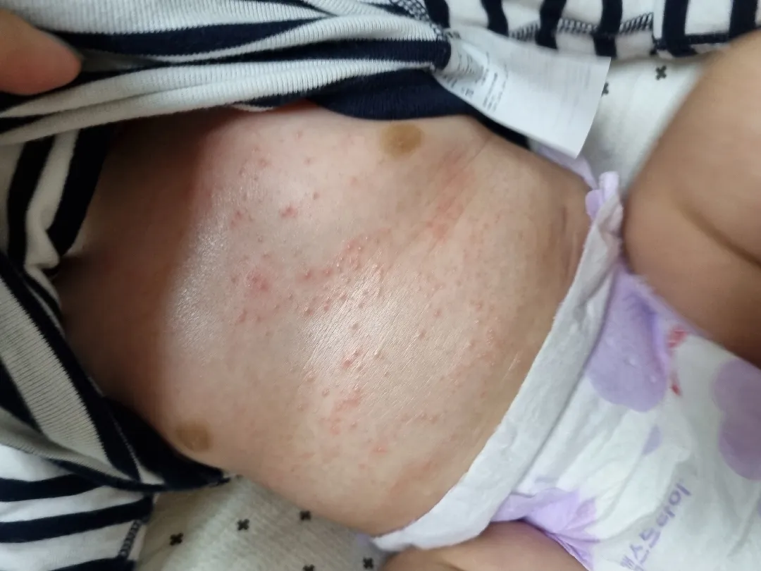 땀띠인가요?