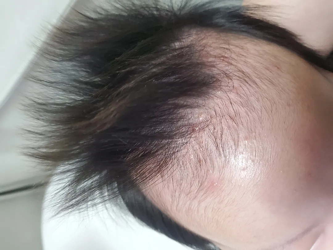 머리 여드름🥲