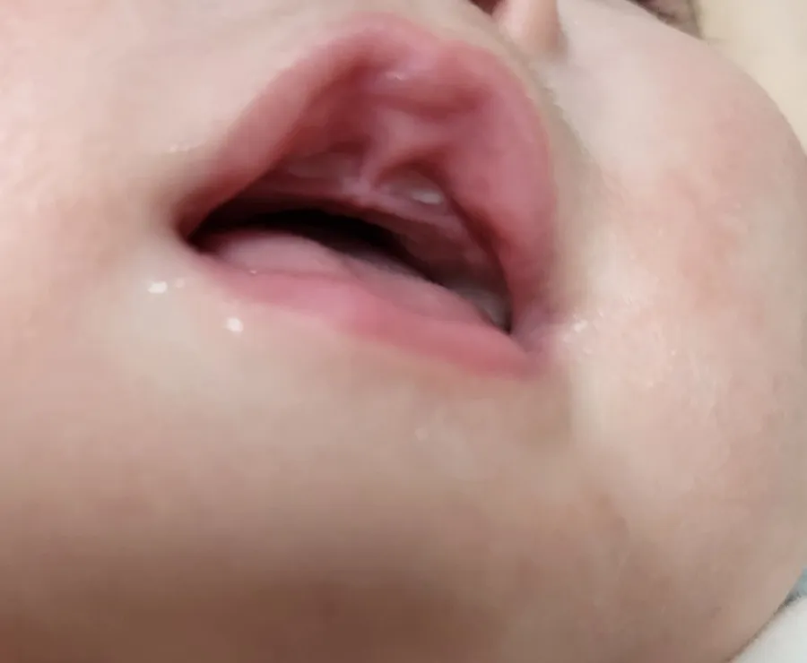 208일.윗니가 올라오고 있어요.