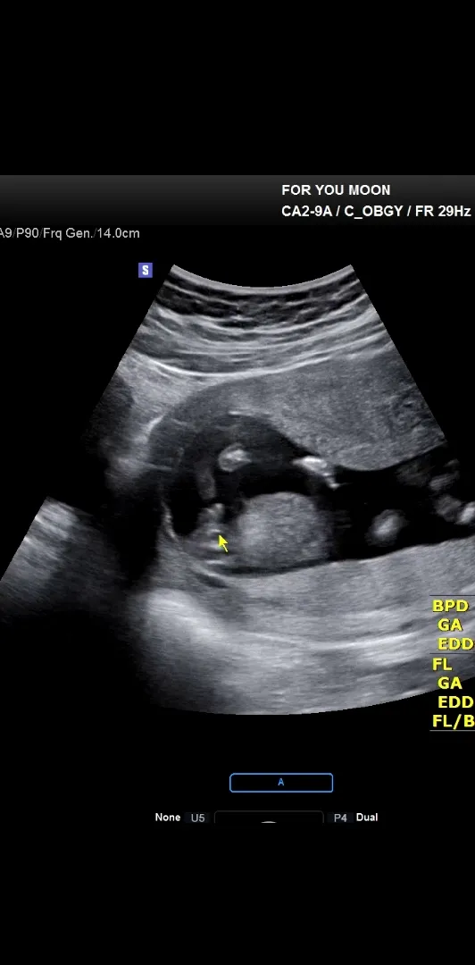 16주 2일 원똥이 성별!!