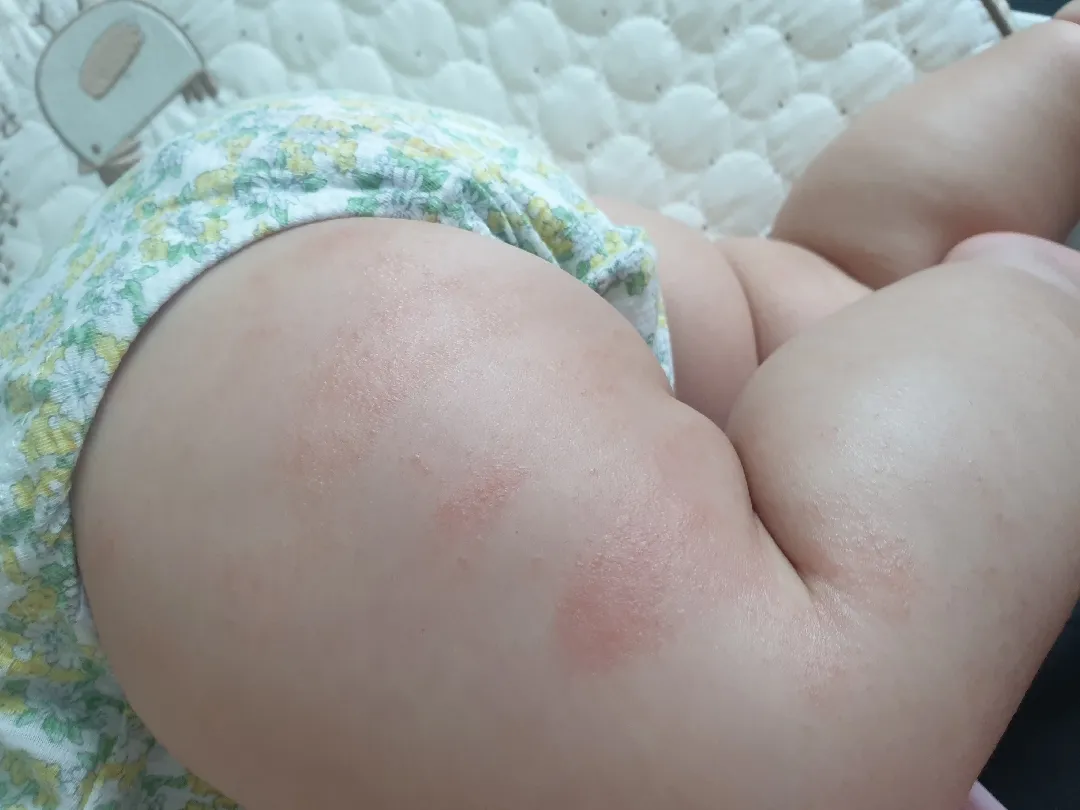 아기피부좀 봐주세요ㅠ