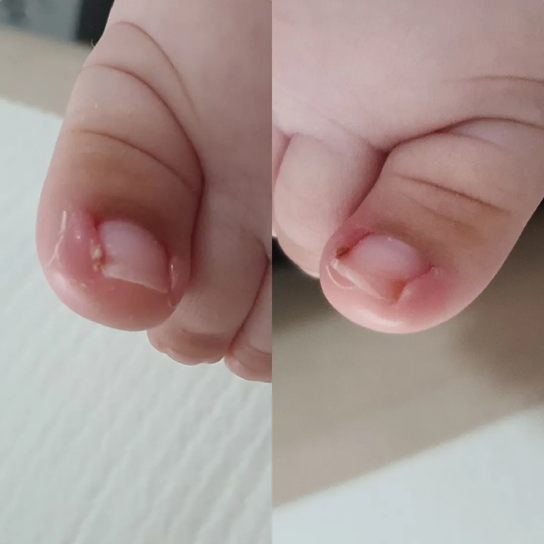 발가락 좀 봐주세요ㅠㅠ