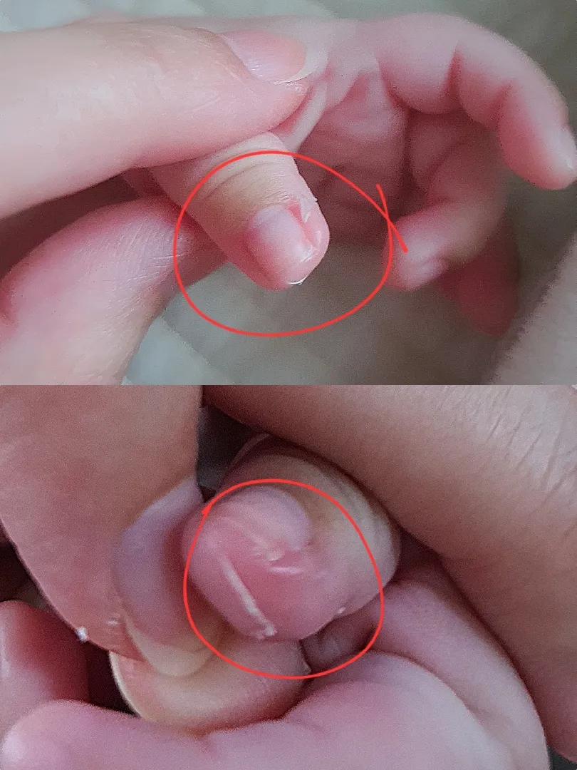 아기 손가락 부르틈