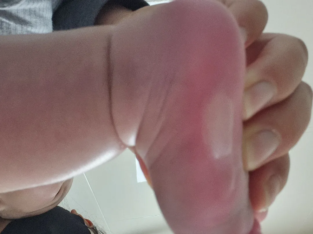 아기 화상 조심하시고 응급대처법 숙지해두세요