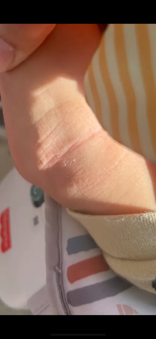 발목 건조해서 그런건가요?? 아토피인가요??