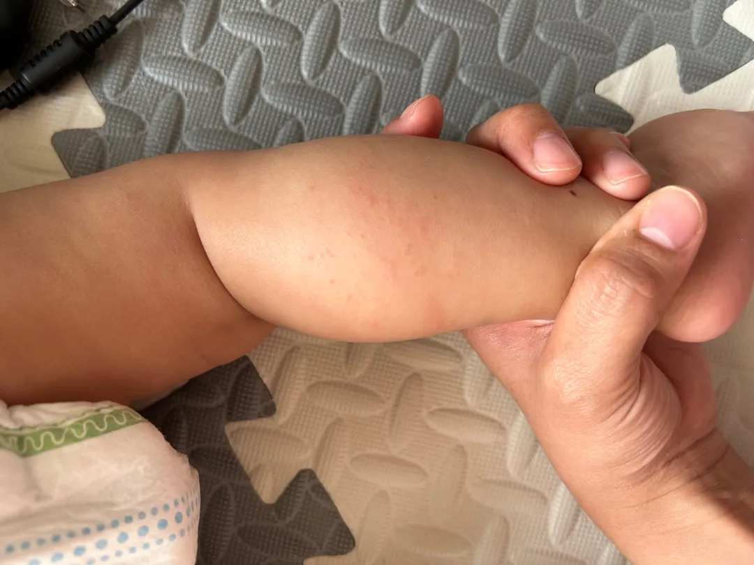 알레르기인가요?? 다리에만 이래요