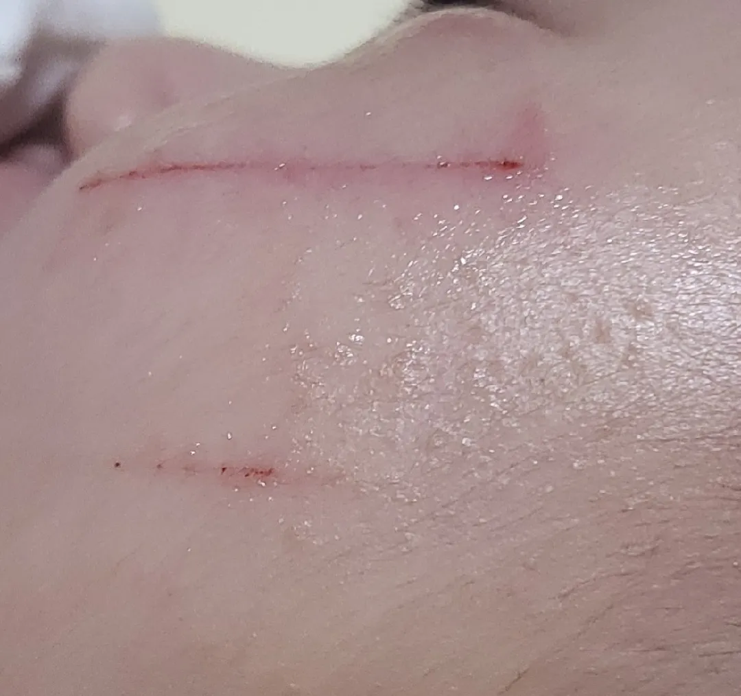 고양이한테물렷어요