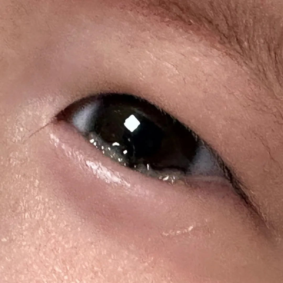 결막염일까요..?