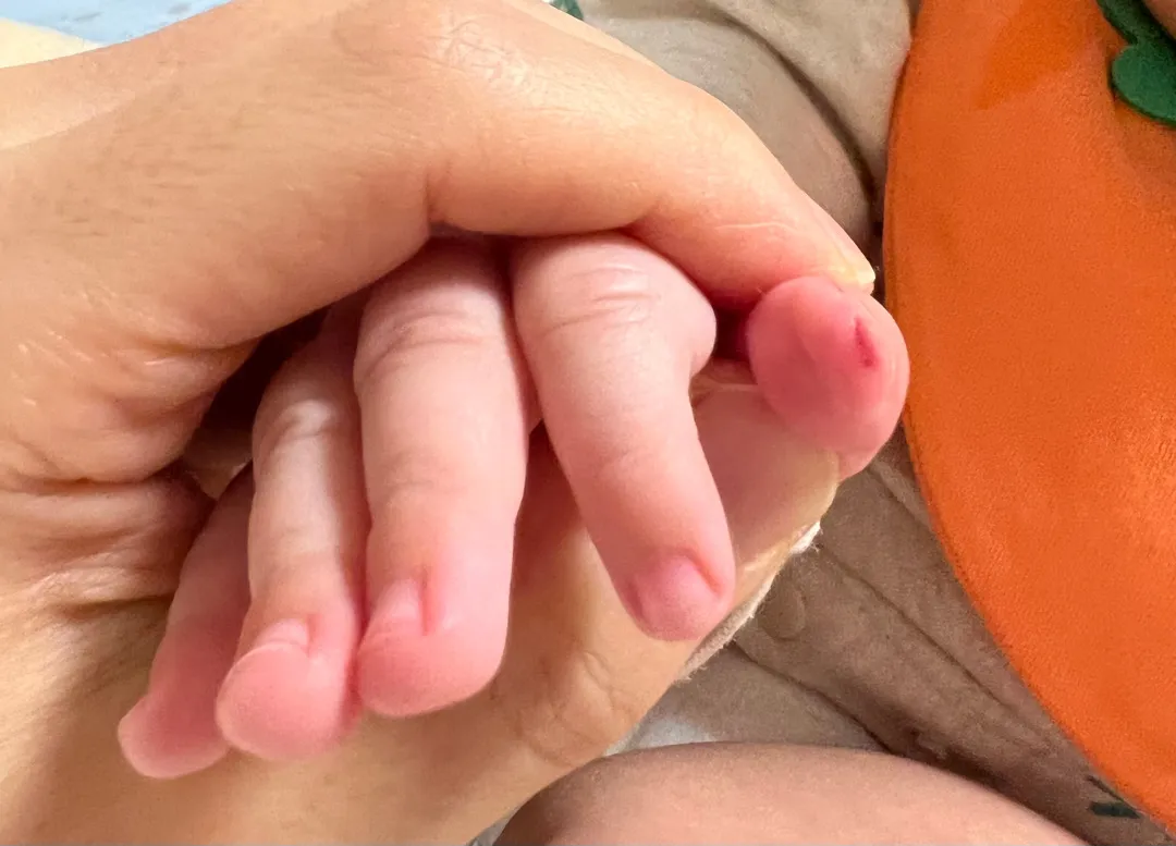 급해요) 손톱깎다가 생긴 상처 병원 가야 할까요😢😭