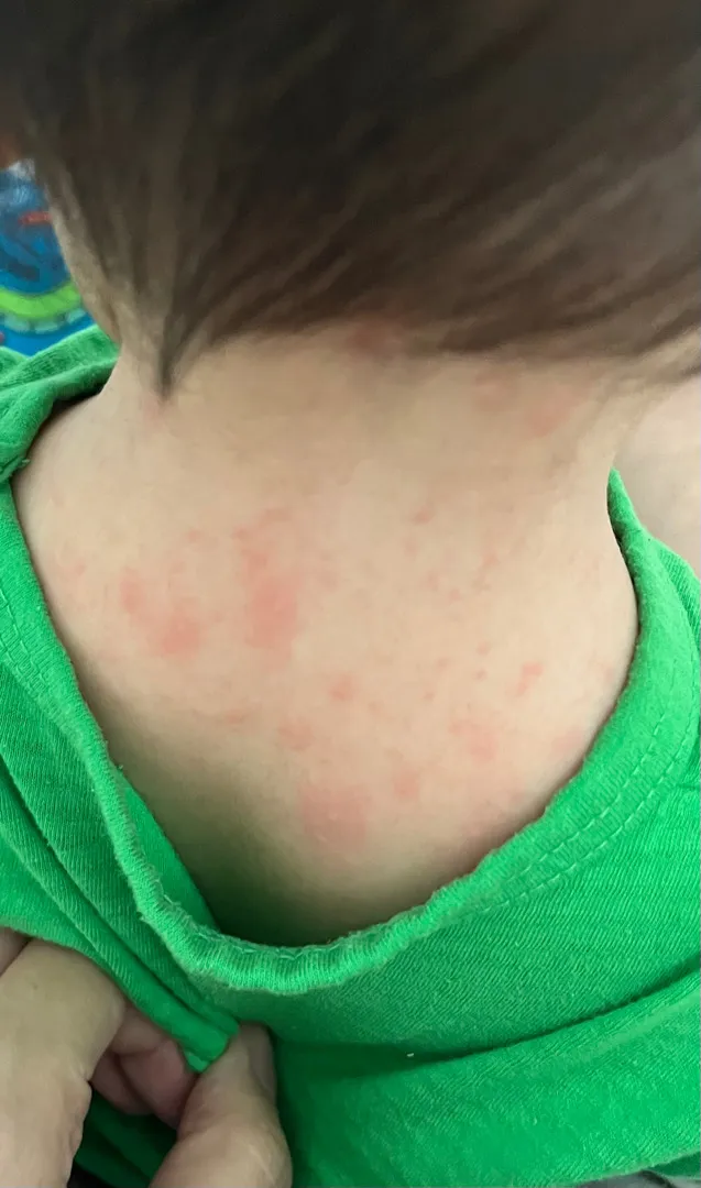 아기 두드러기 땀띠??