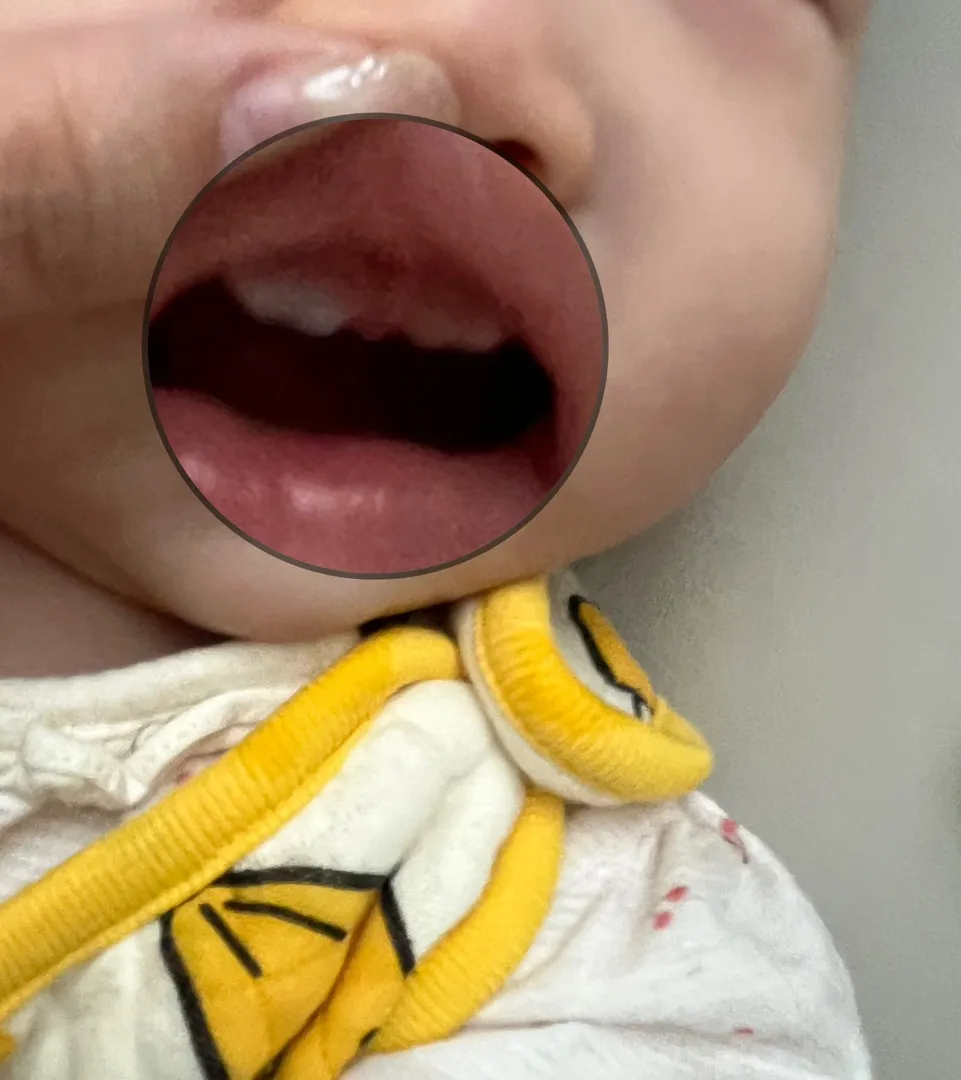 7개월 치아