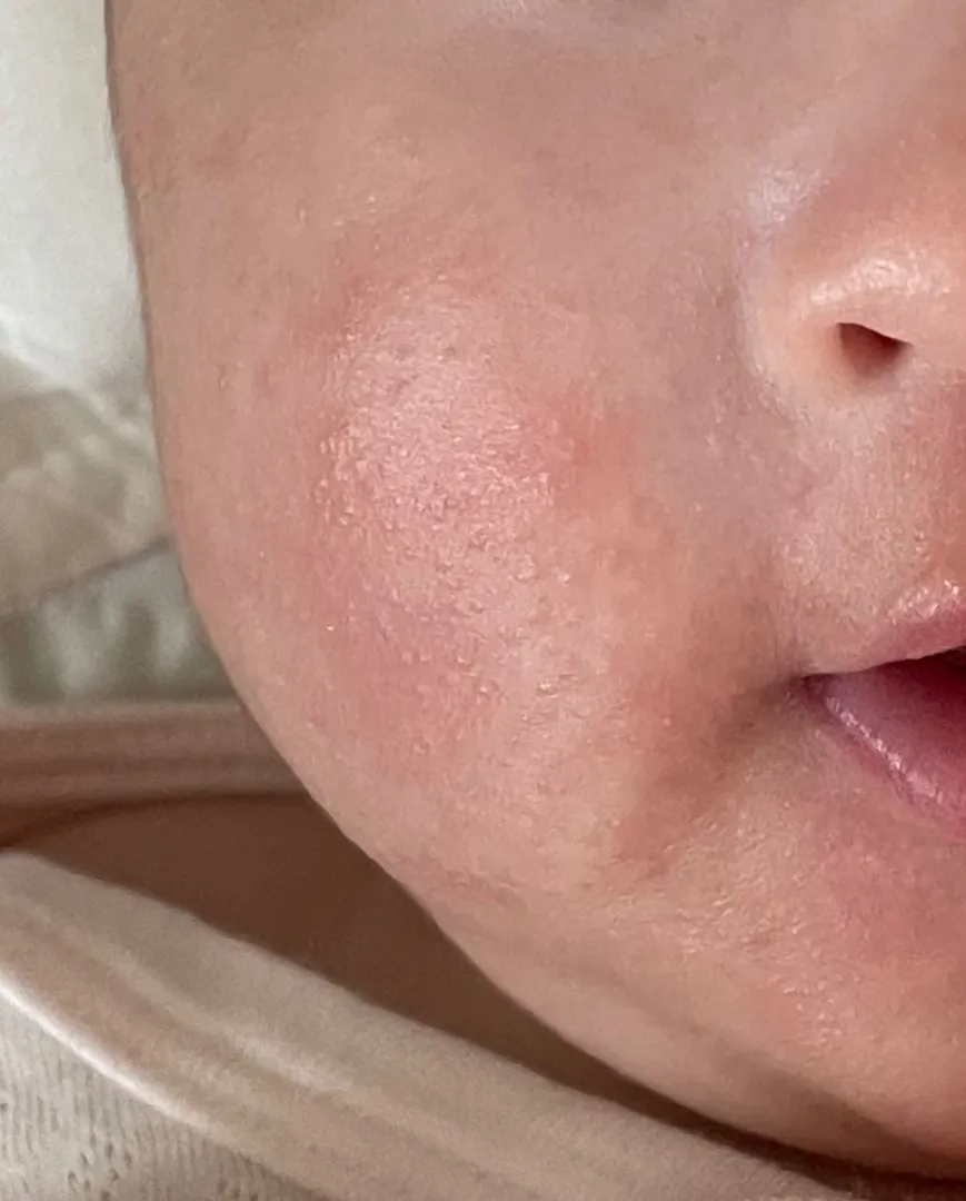 좁쌀 트러블 조언 구해요 ㅠㅠ(78일차 아기)