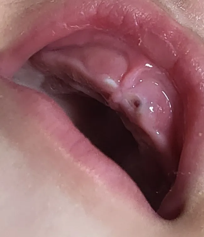 윗니날때 까만점같은게있어요