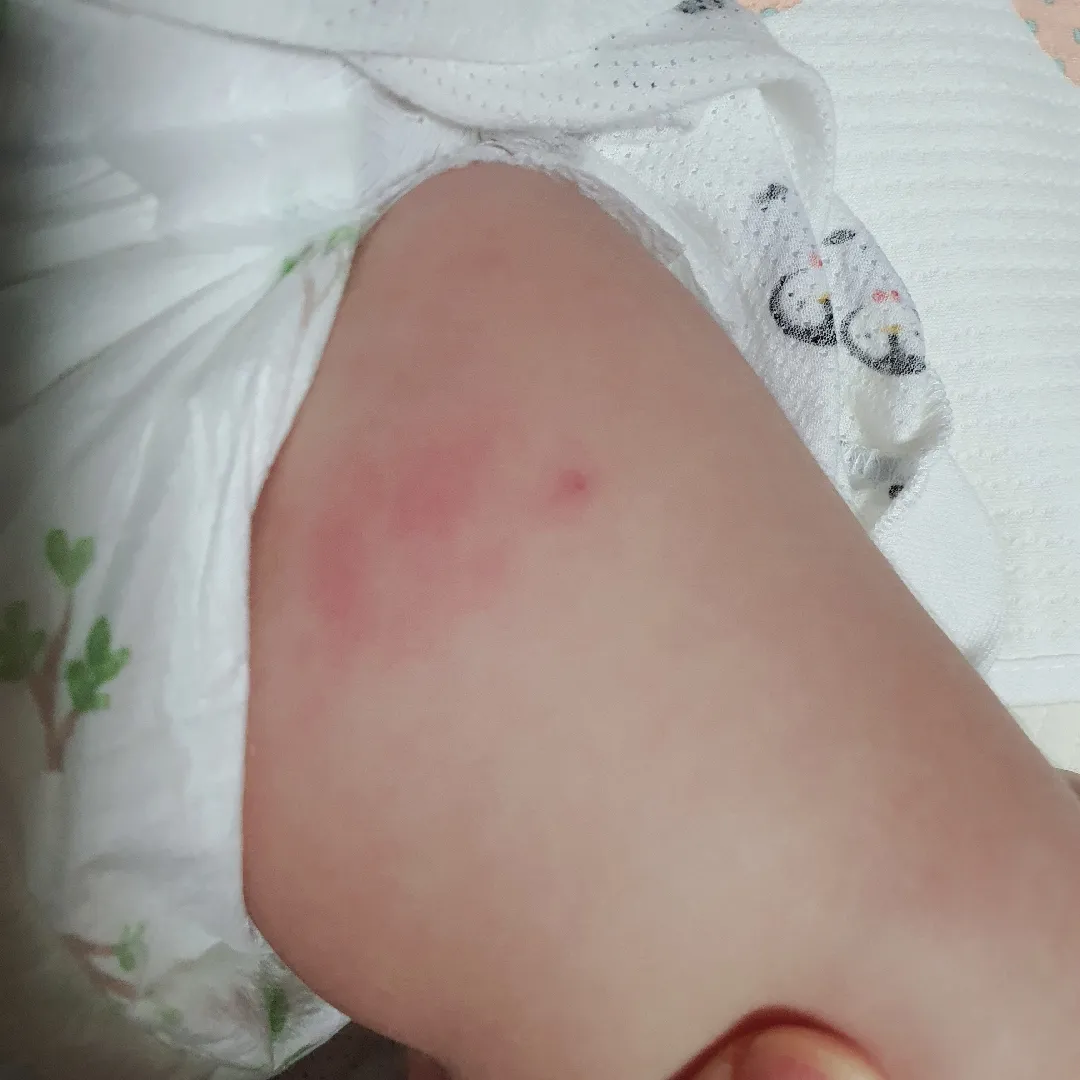 접종부위 발적
