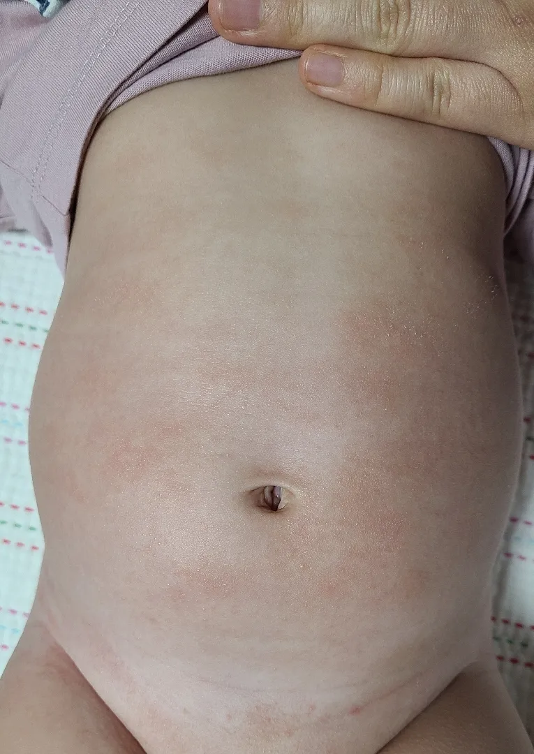 160아기 배에 태열인가요? 알러지? 건선? 기저귀 발진?뭘까요ㅜ