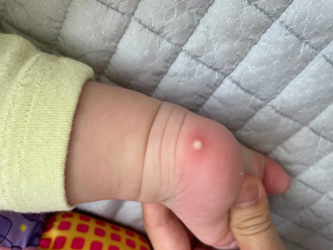 발뒤꿈치에 이거 뭘까요?ㅠㅠ