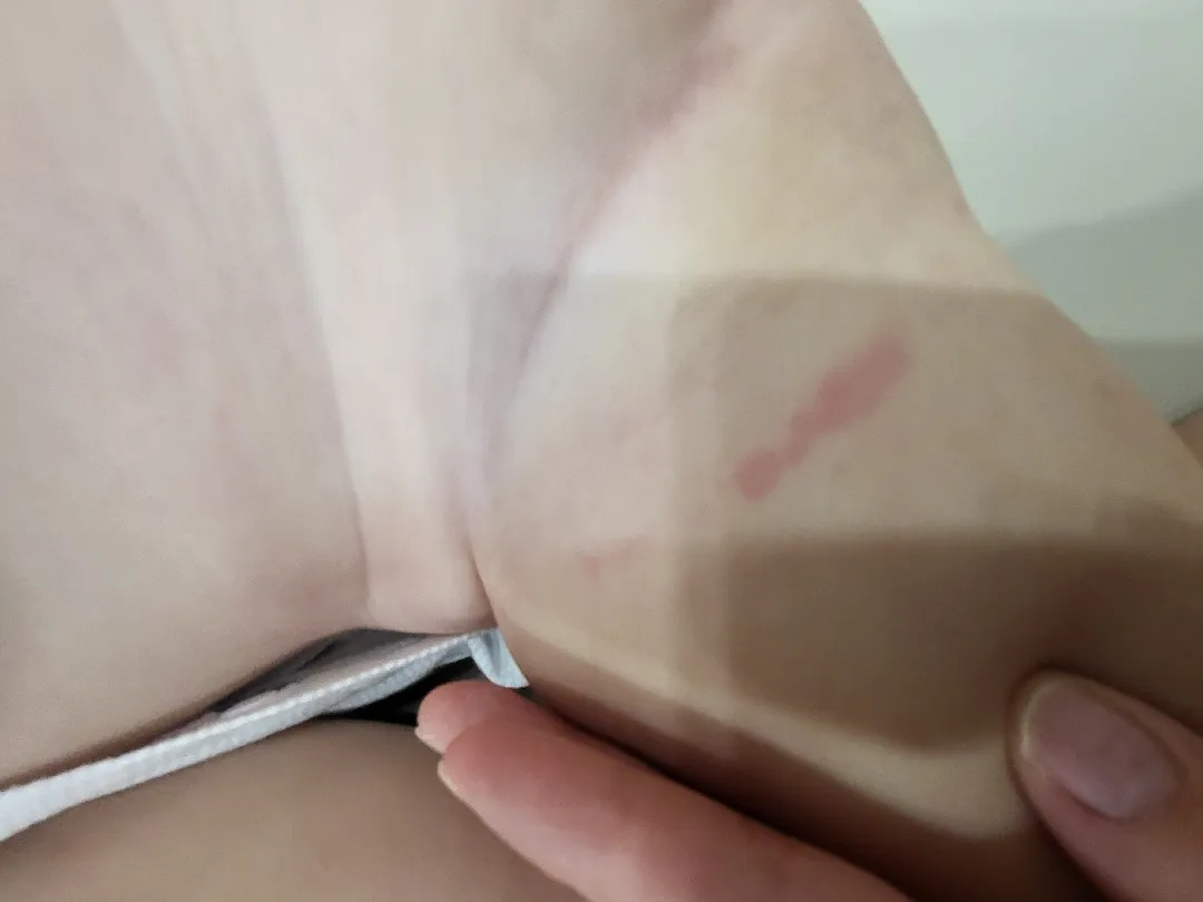 아기피부 왜그런걸까요(사진있음)