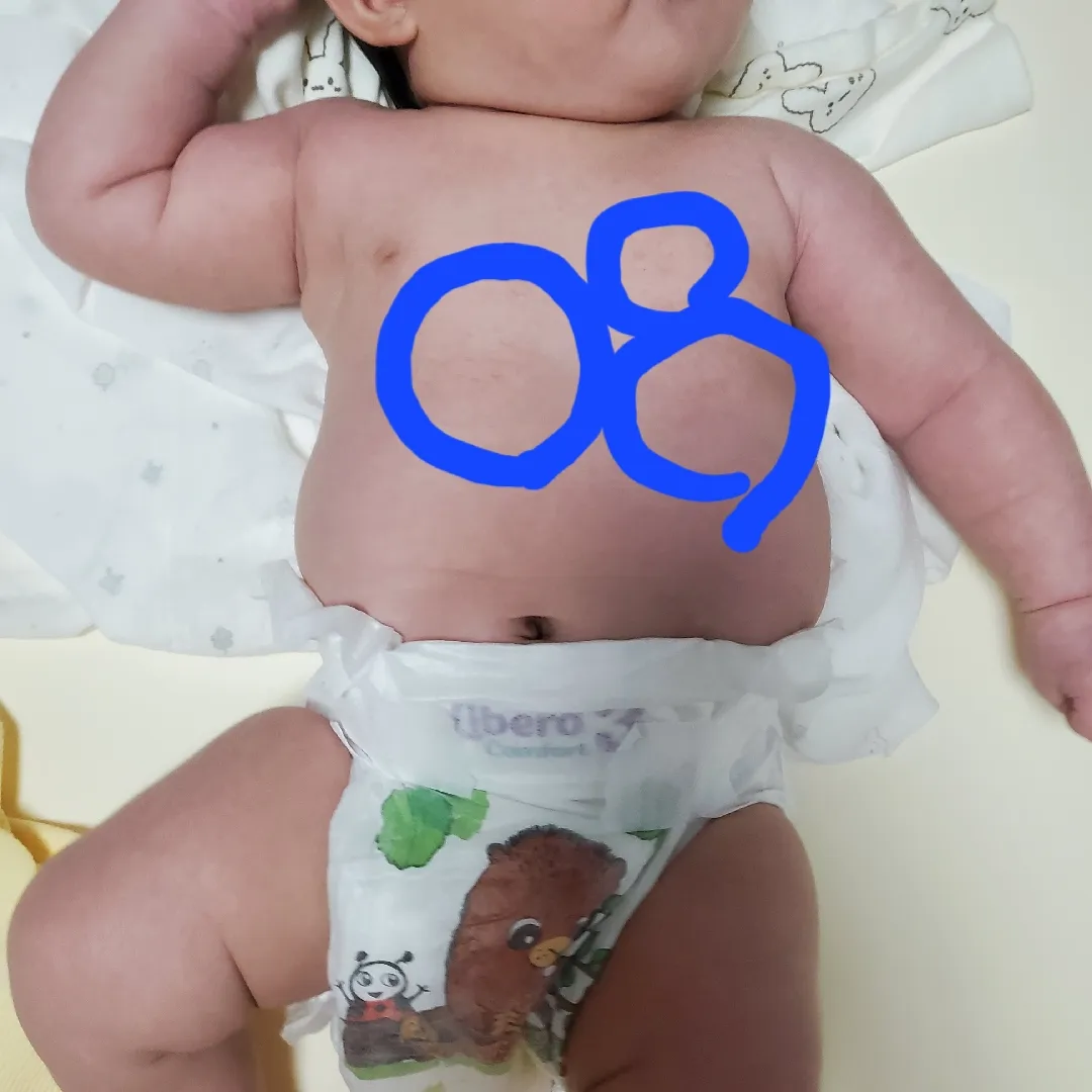 아기땀띠일까요?