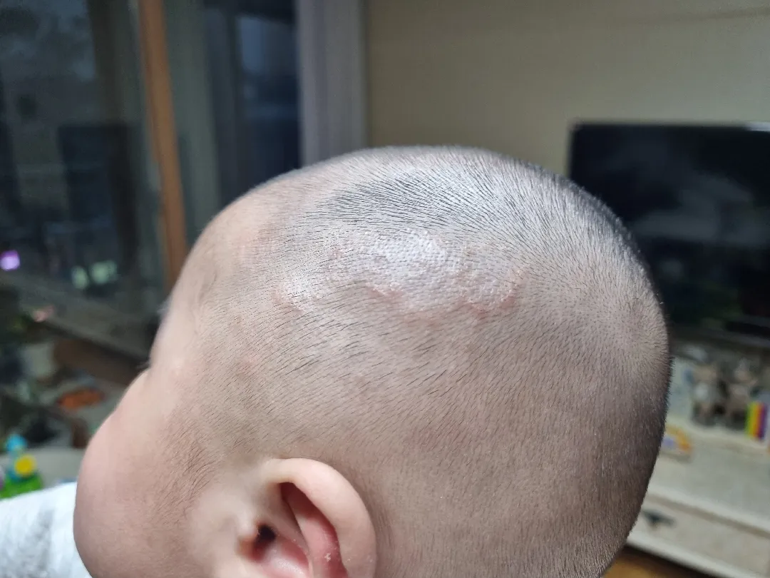 140일차 아기 머리에 두드러기가 계속 번져요