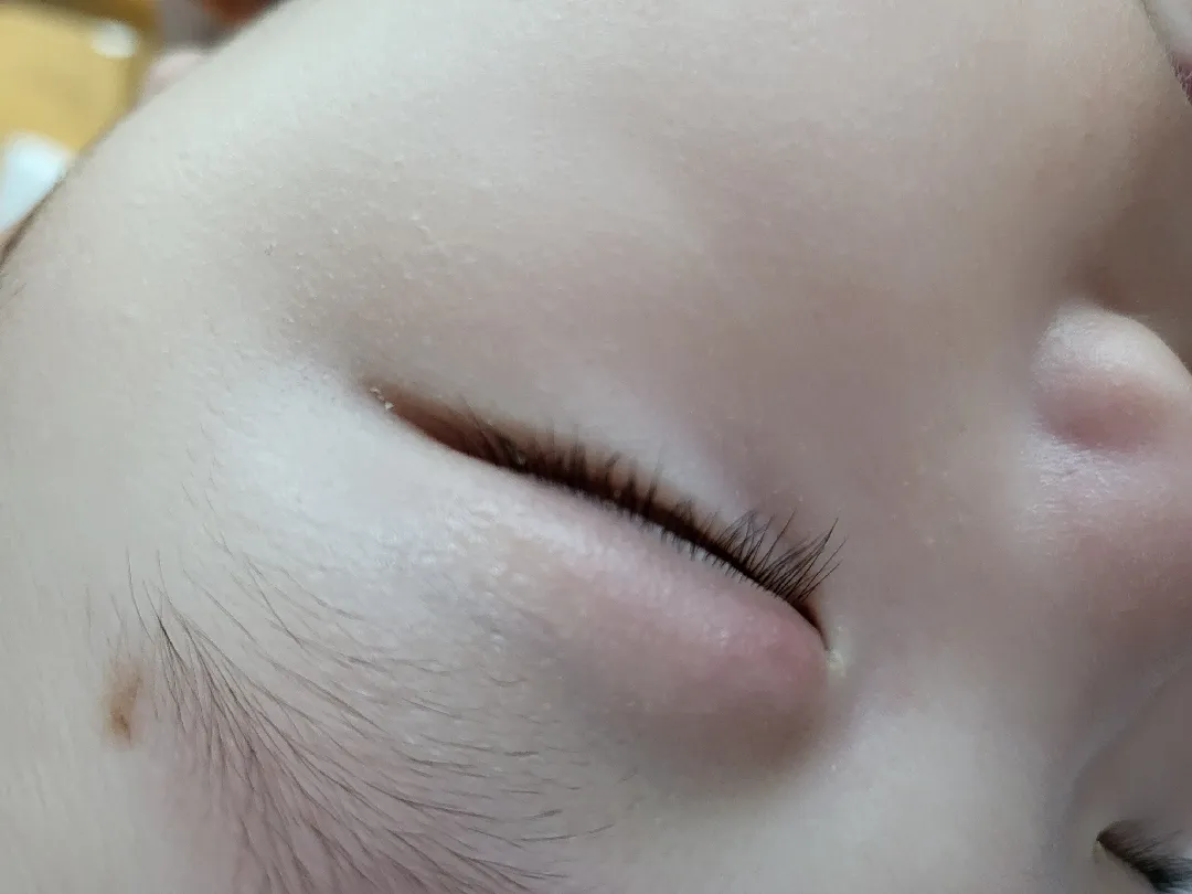 다래끼일까요?ㅠㅠ