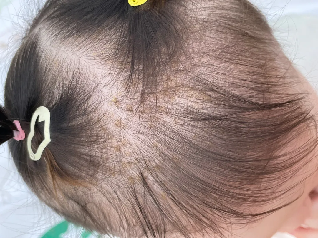 아기머리에 딱지(?) 언제 없어질까요?