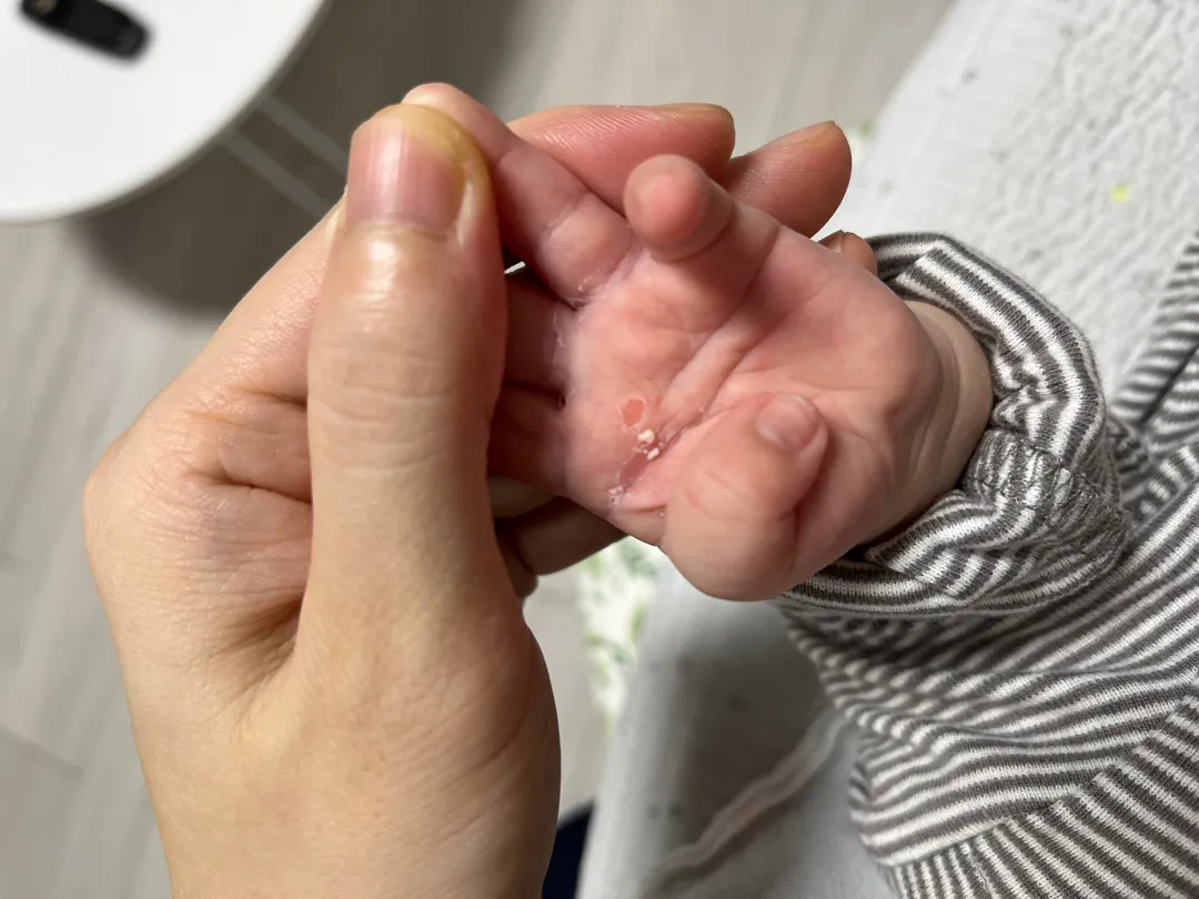 45일차 아기 손바닥 손싸개 때문일까요?