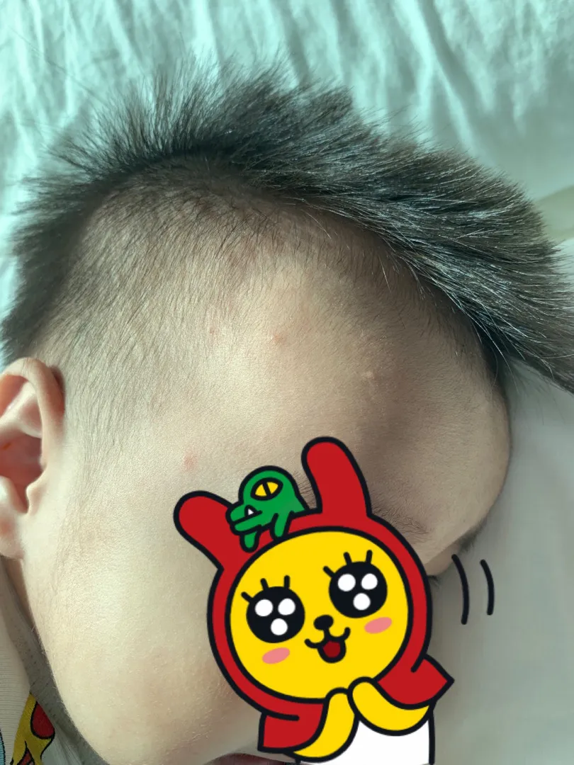 오돌토돌 뾰루지