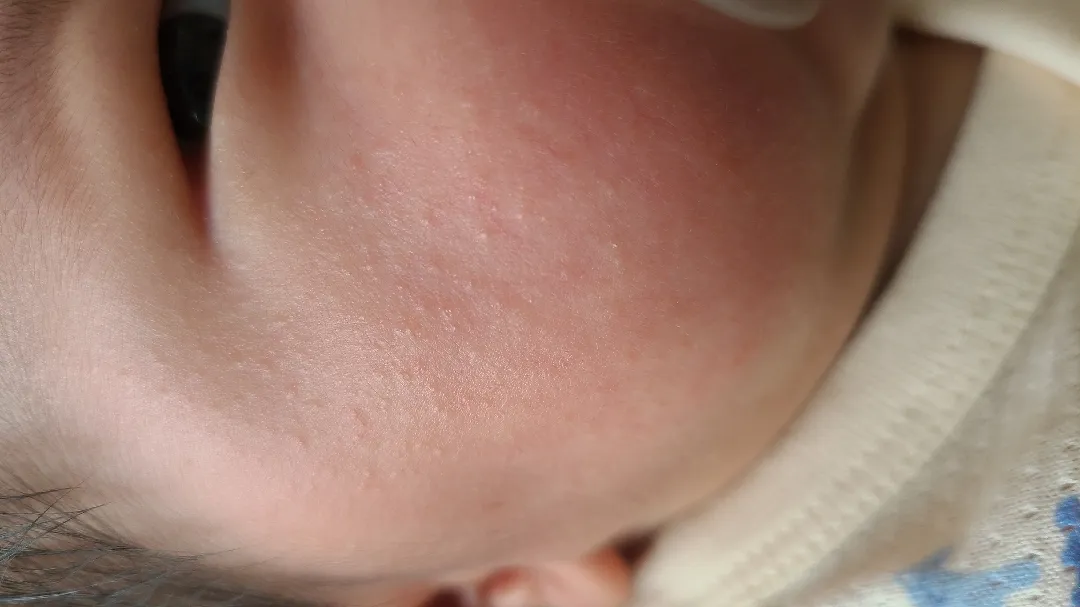 43일 아이 피부에 이게 뭘까요?