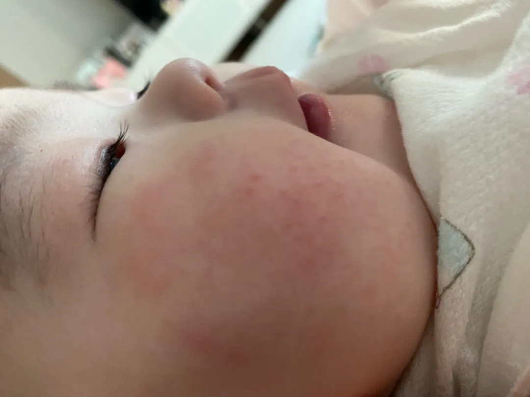 아가야 볼이 왜이럴까요