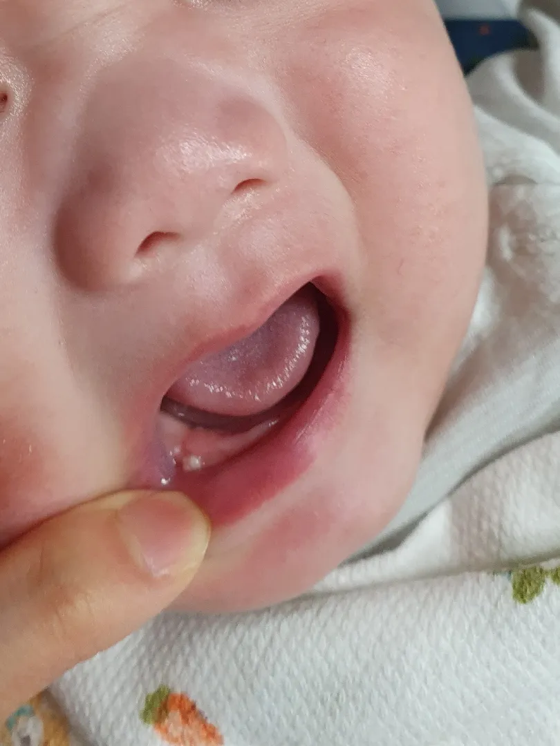 아기잇몸 좀 봐주세 요ㅜㅠ