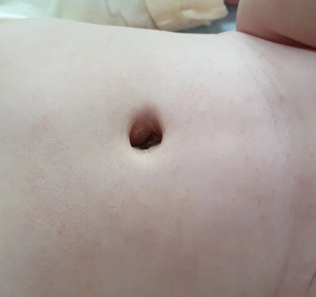 땀띠맞는지 봐주세용ㅠㅠ