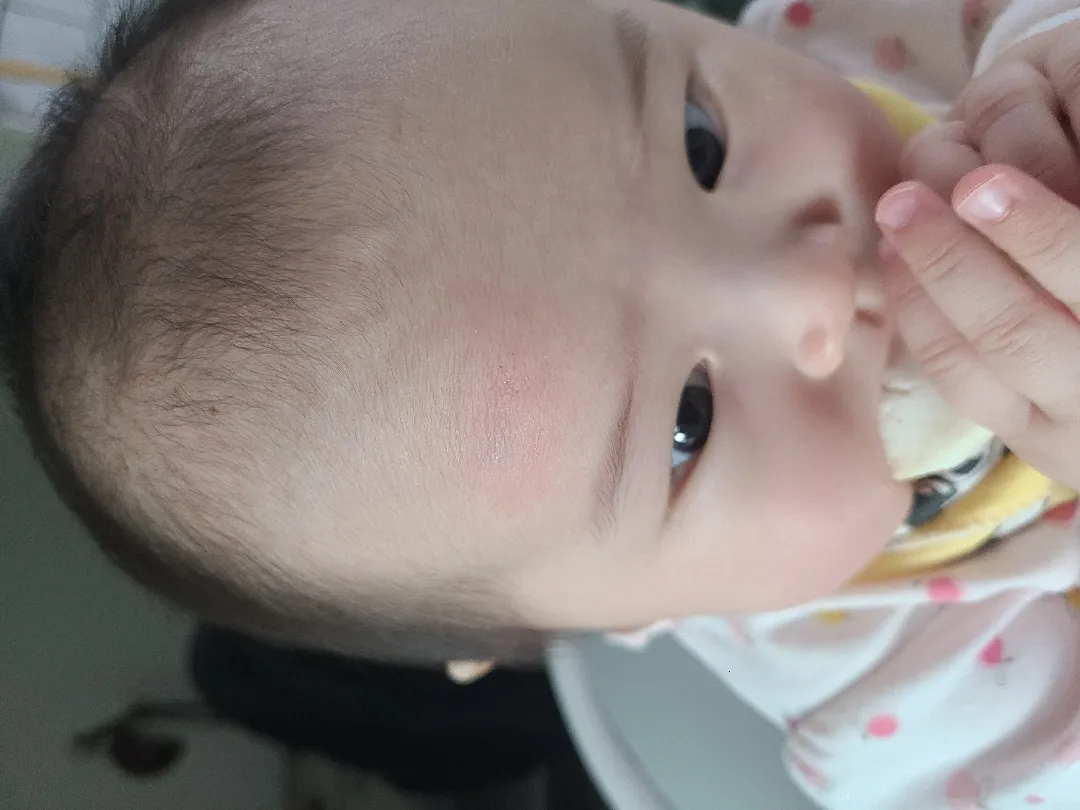 아기 머리 쿵했는데 혹이랑 피멍이...ㅜ