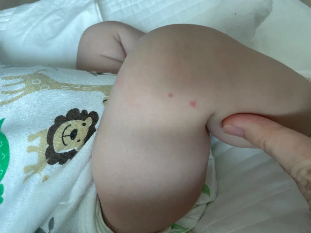 모기물린건가요?