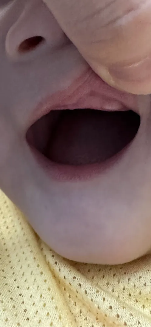 7개월아기 윗앞니