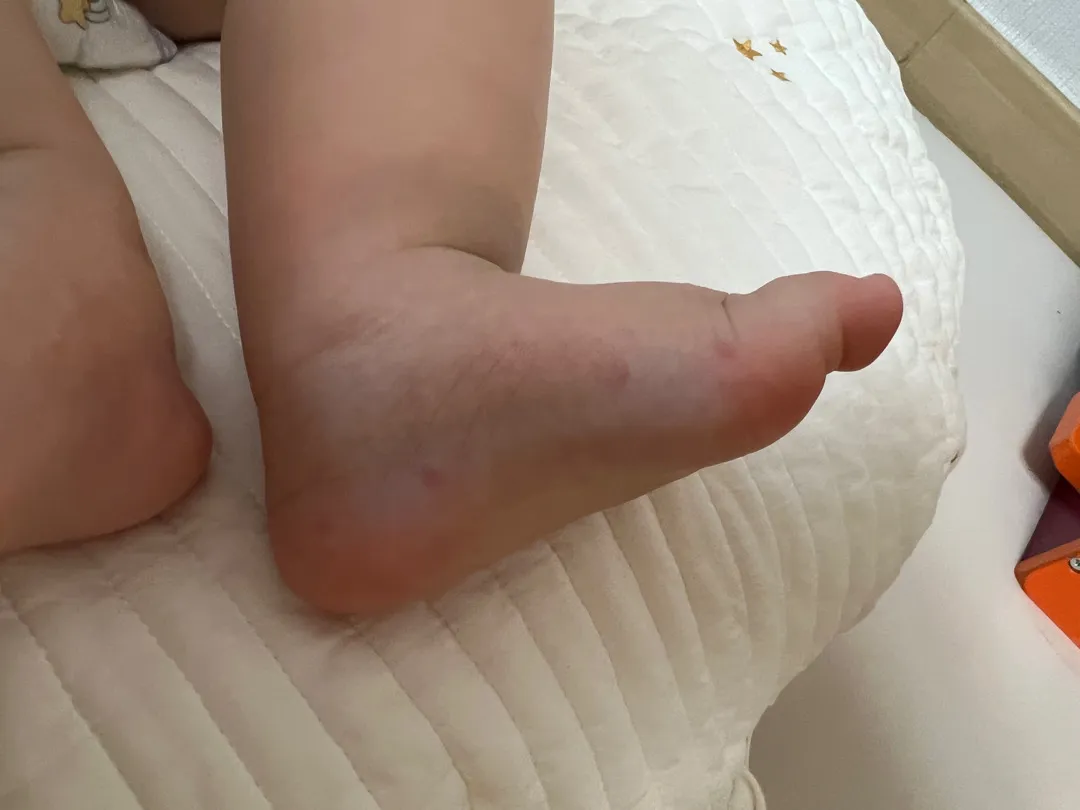 발에 붉은 자국 뭘까요? 