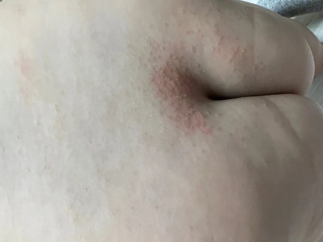 아기 피부 이거 뭔가요? 2
