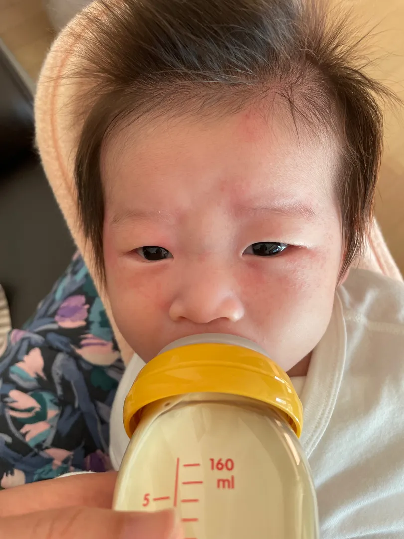 태열일까요?아토피일까요?ㅠㅠ
