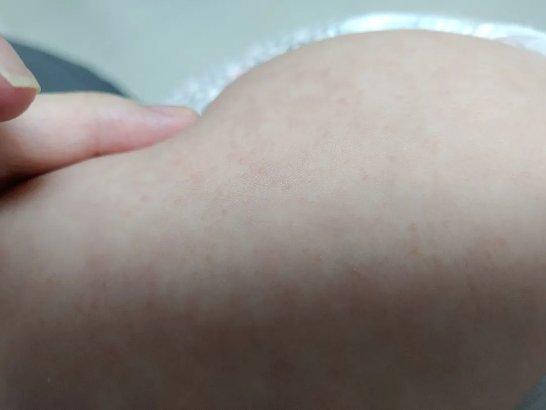 아기 다리피부좀 봐주세요