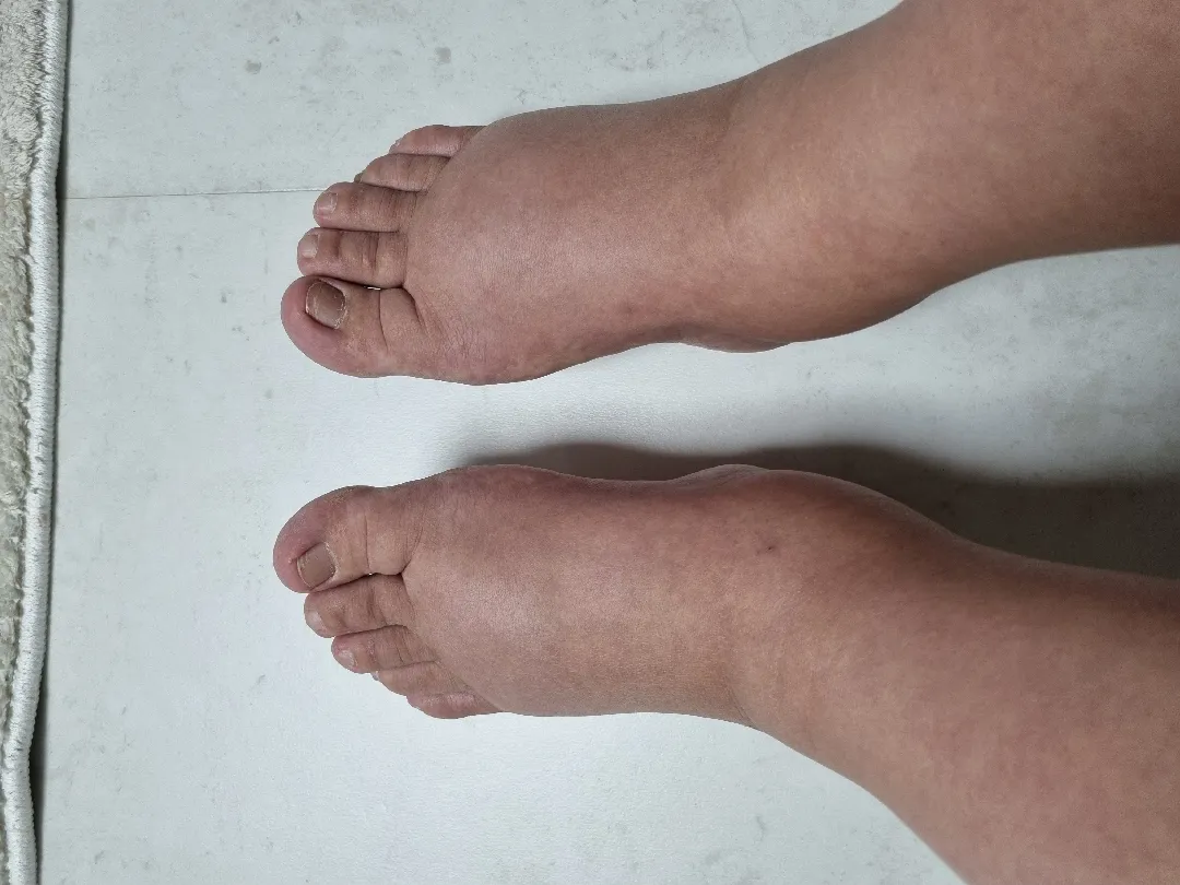 사진 혐오주의] 발이  이렇게  부을수있나요?ㅠㅠ
