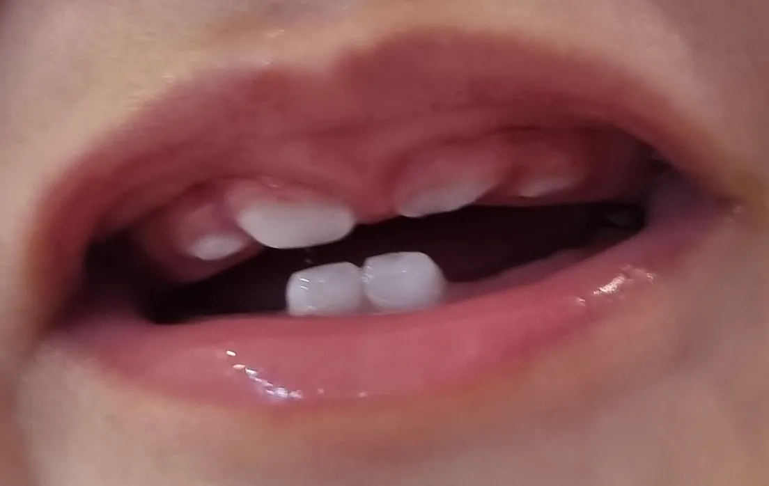 아기윗니