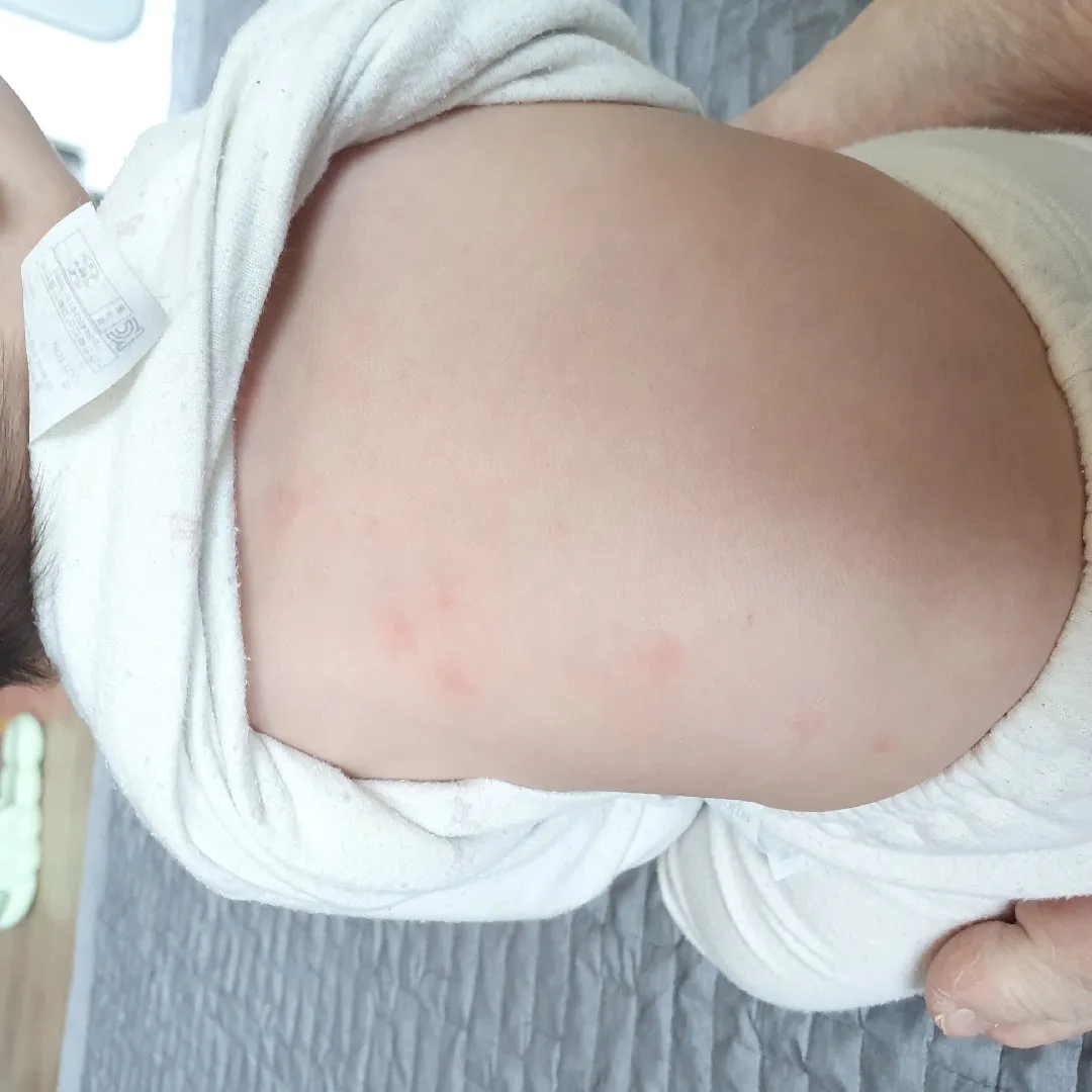 7갤 아기 등에 뭐가 났는데.. 뭘까요?