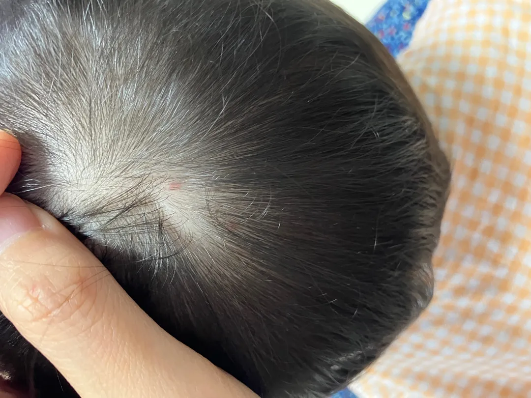 아기 두피 왜 이럴까요?