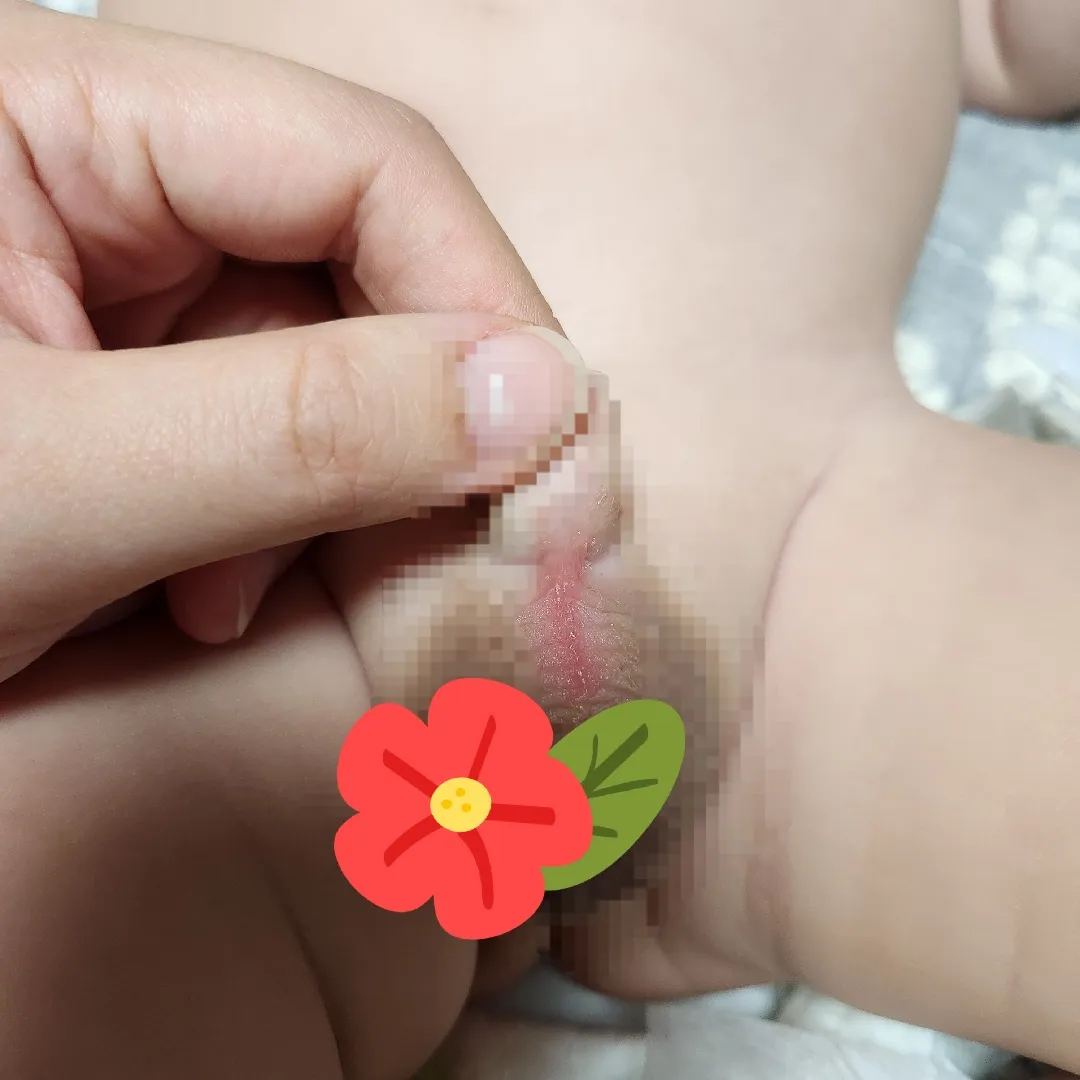 남자아기 성기밑에 빨개졌어요