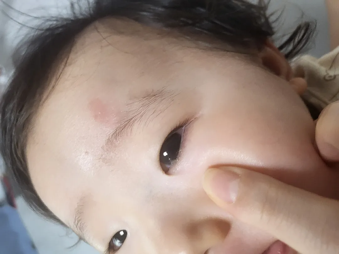애기 눈에 이물감이 있네요.봐주세요